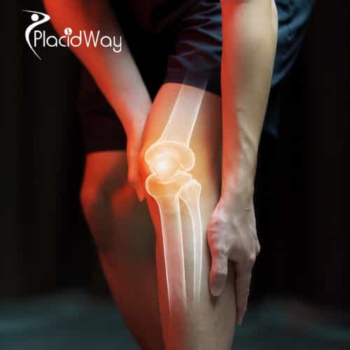 Joint Replacement Surgery in Turkey for Patients Seeking Advanced Orthopedic Solutions